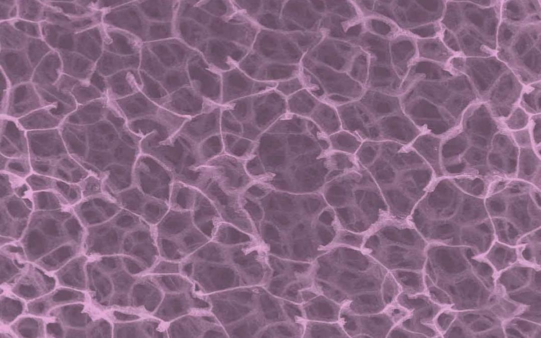 Osteoarthritis Pain Eased by Graphene Foam Suggested by Research