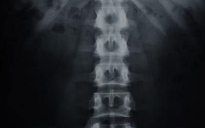 N2 Biomedical Announces The First Surgical Implant Of A Spinal Device Coated With The Company’s Thin, Ion-Assisted Titanium Coating Technology